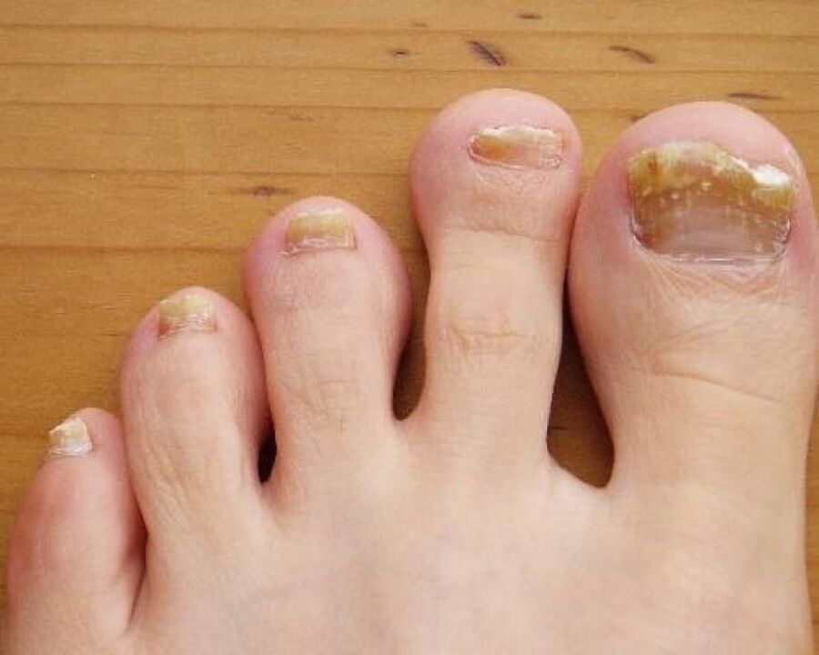 yellowing of the nail plate due to fungus