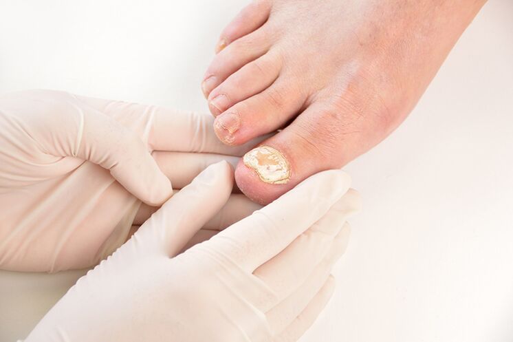 Before prescribing treatment, the doctor needs to diagnose the fungus of the toenails