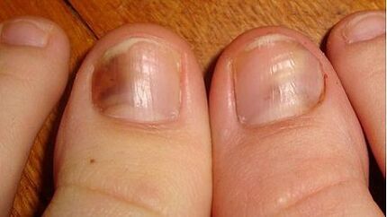 A sign of mycosis is the darkening of the nail plate