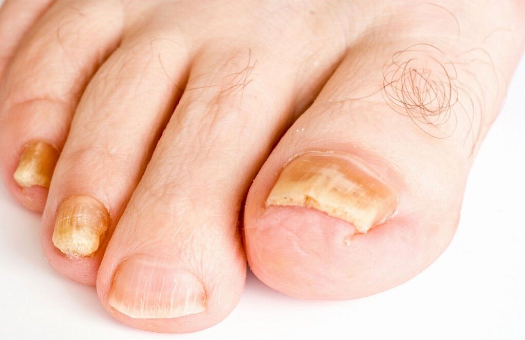 toenail fungus