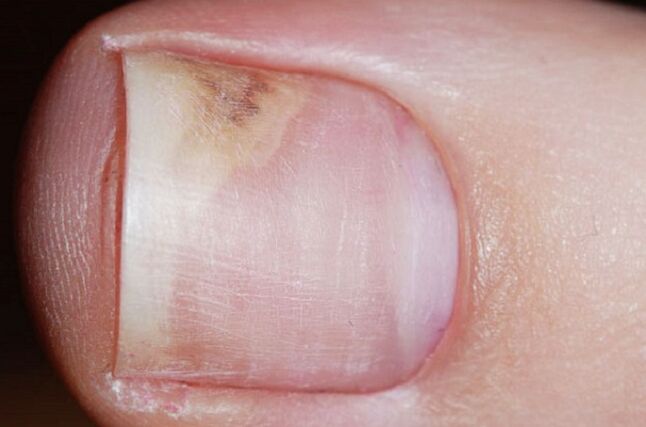 Signs of onychomycosis at the initial stage - lack of shine, a gap between the nail and the bed