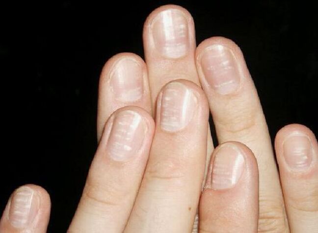 White spots on fingernails are a sign of developing fungus