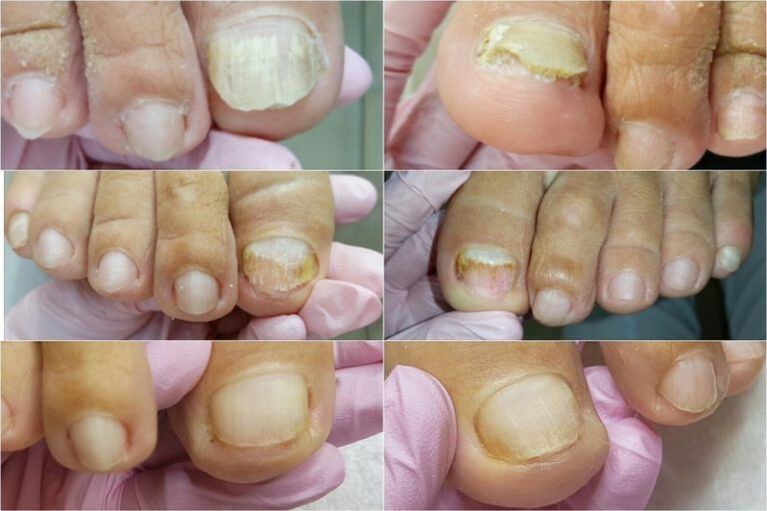 signs of fungus on nails