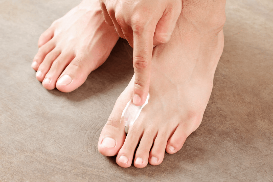 applying antifungal ointment to the skin of the foot