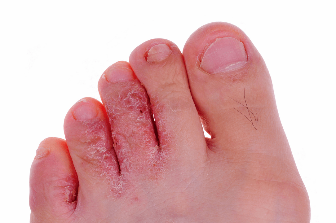 fungal infection of the skin between the toes
