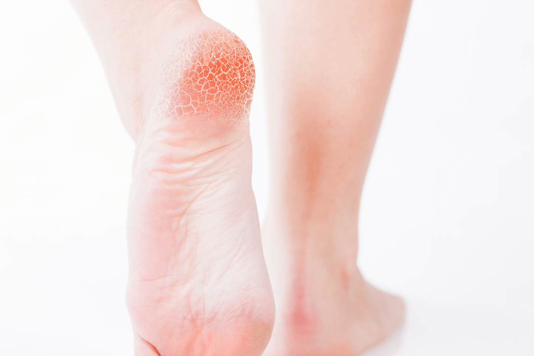 treatment of early stage foot fungus