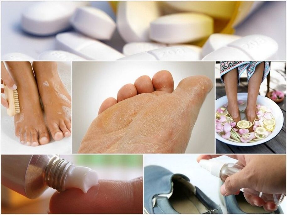preventing fungal nail infections