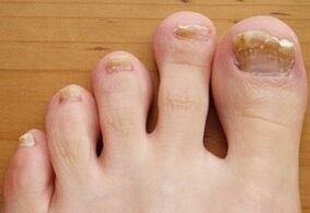 Runned onychomycosis