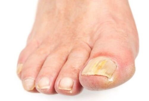 Fungus on the nails