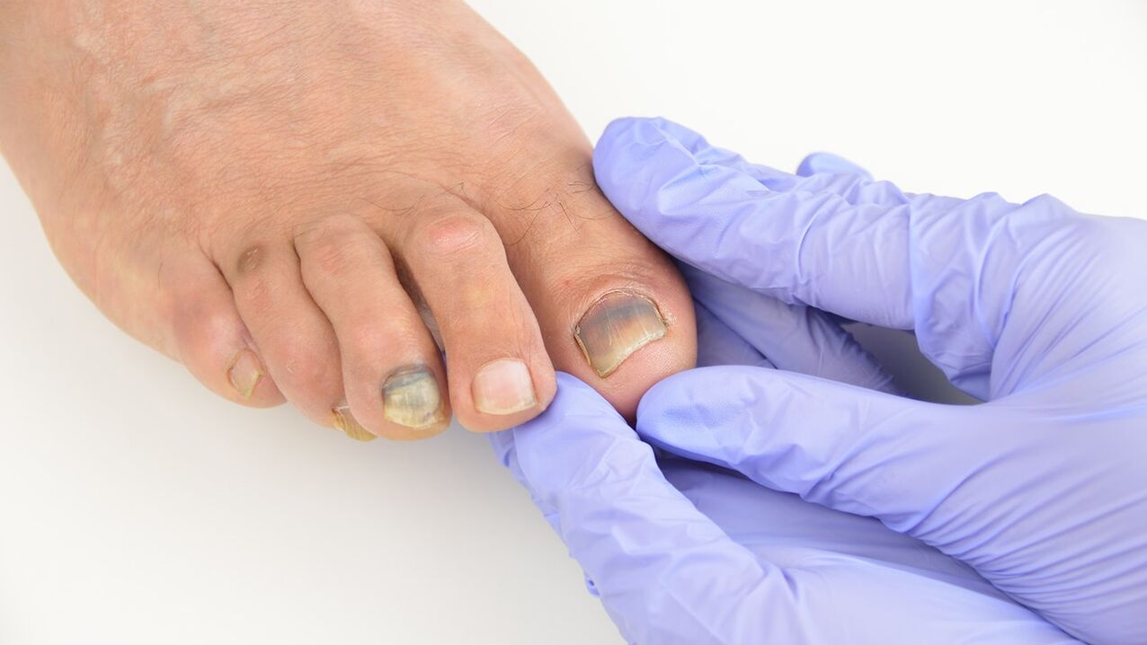 Inspection of the fungus of the foot