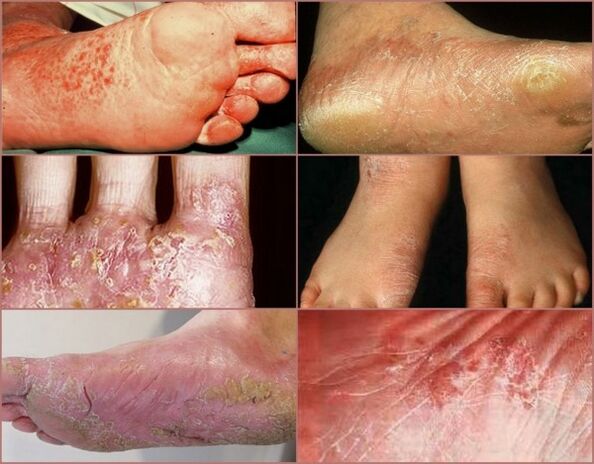 Dyshidrotic stage