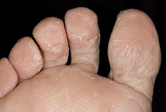 Types of fungus of the legs