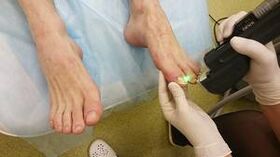 Hardware treatment of fungus