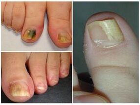 What the fungus on the nails looks like