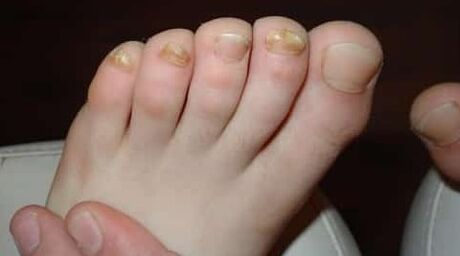 Almost all the fingers are affected by the fungus