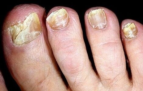 Nails crumble from the fungus
