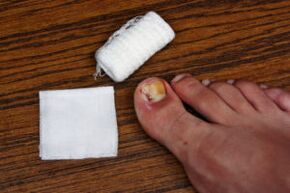 Compress with apple cider vinegar for the treatment of fungus