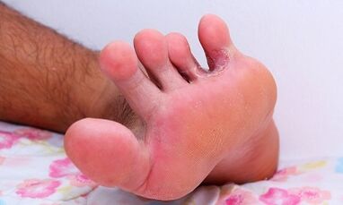 The causes of the fungus between the toes