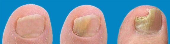 Fungus development process