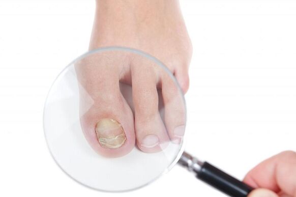 stages and stages of development of fungus on toenails