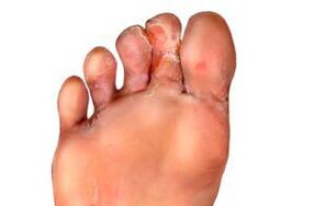 fungus between fingers