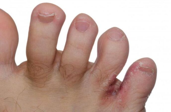 fungus on the feet between the toes