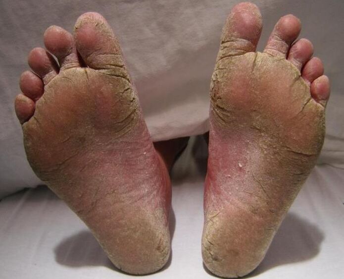 squamous-hyperkeratic fungus on the legs