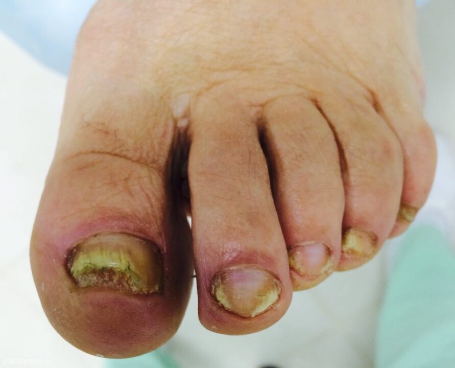 Severe deformation of toenails is a sign of the third advanced stage of the fungus