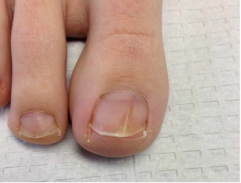 Stripes and spots on the big toe nail during the first stage of fungal development