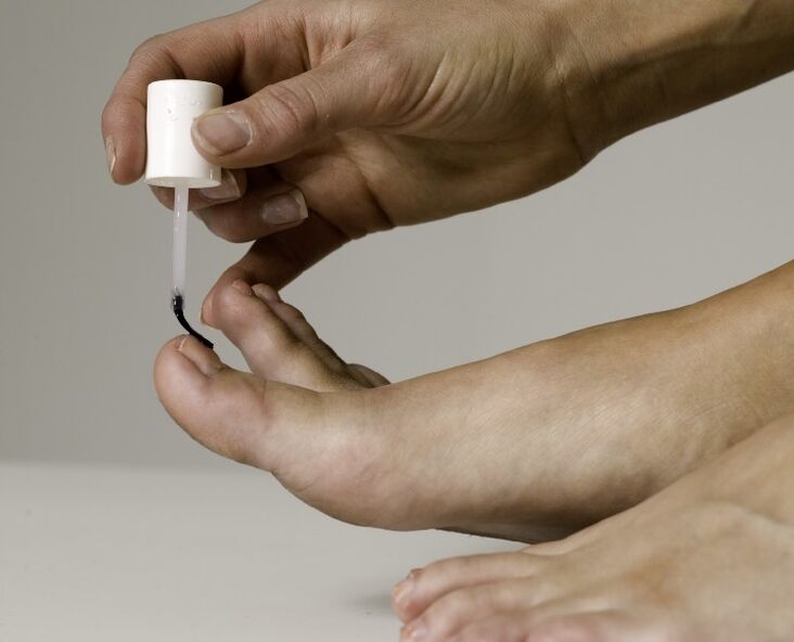 The use of medicinal varnish for the treatment and prevention of onychomycosis on the big toe