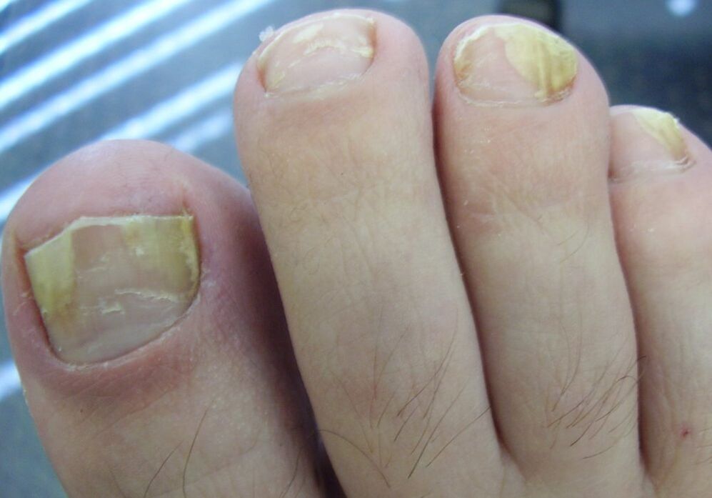 Yellow color of the nail plate at the second stage of fungal infection